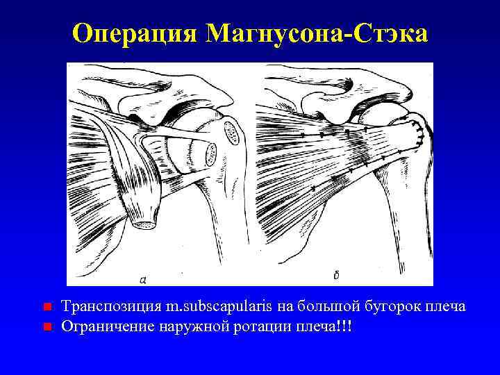 Операция Магнусона-Стэка n n Транспозиция m. subscapularis на большой бугорок плеча Ограничение наружной ротации