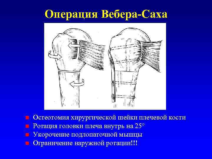 Операция Вебера-Саха n n Остеотомия хирургической шейки плечевой кости Ротация головки плеча внутрь на