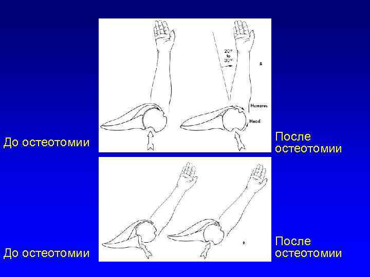 До остеотомии После остеотомии 