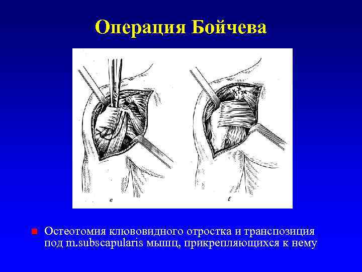 Операция Бойчева n Остеотомия клювовидного отростка и транспозиция под m. subscapularis мышц, прикрепляющихся к