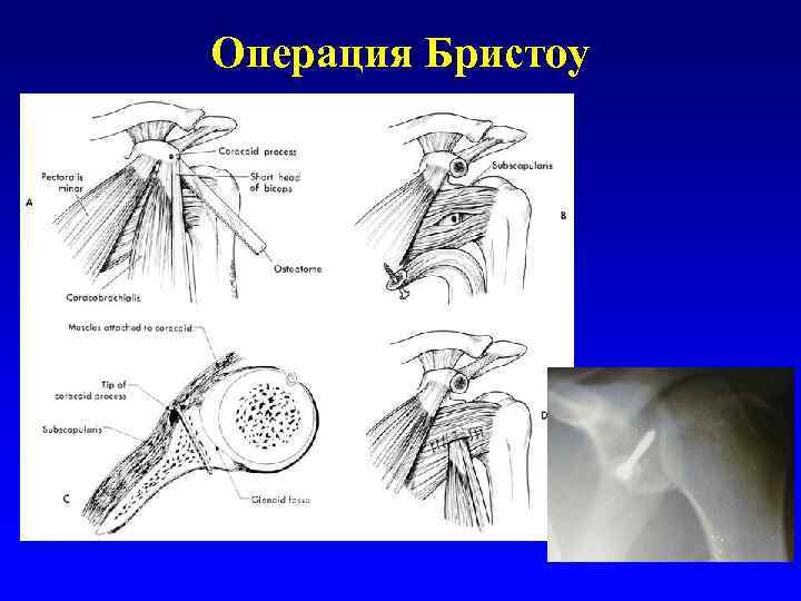 Операция Бристоу 