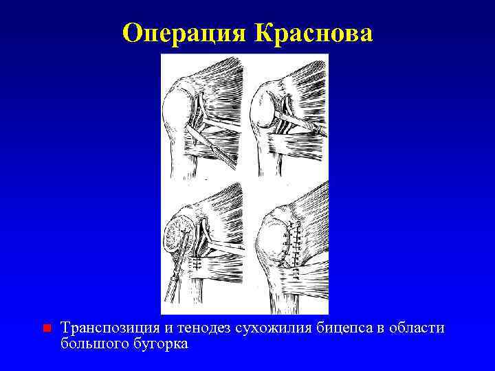 Операция Краснова n Транспозиция и тенодез сухожилия бицепса в области большого бугорка 