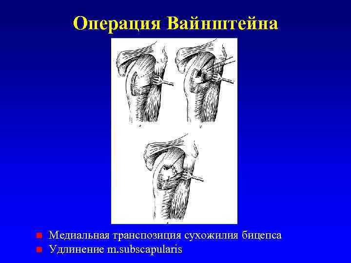 Операция Вайнштейна n n Медиальная транспозиция сухожилия бицепса Удлинение m. subscapularis 