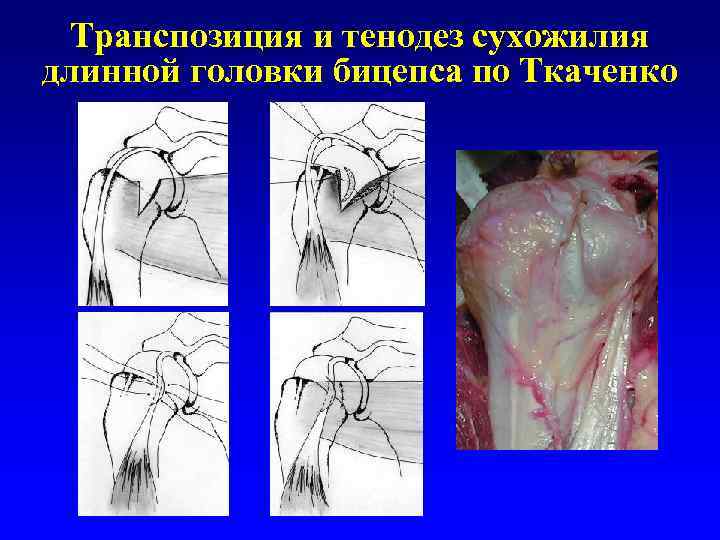 Транспозиция и тенодез сухожилия длинной головки бицепса по Ткаченко 