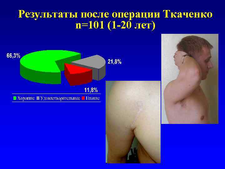 Результаты после операции Ткаченко n=101 (1 -20 лет) 