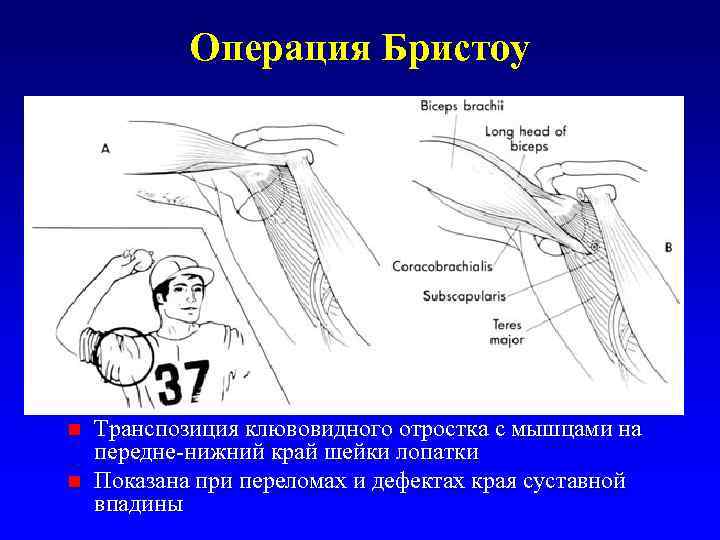 Операция Бристоу Транспозиция клювовидного отростка с мышцами на передне-нижний край шейки лопатки n Показана