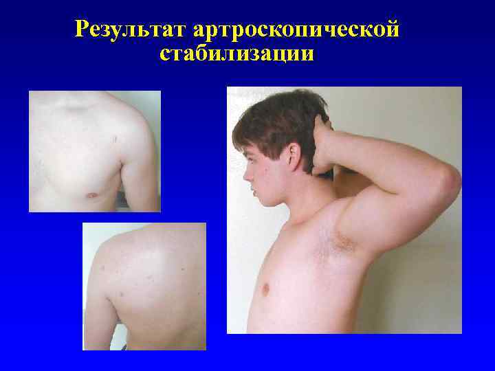 Результат артроскопической стабилизации 