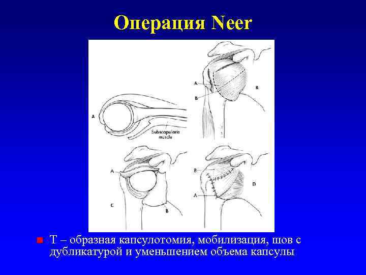 Операция Neer n Т – образная капсулотомия, мобилизация, шов с дубликатурой и уменьшением объема