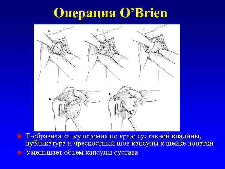 Операция O’Brien Т-образная капсулотомия по краю суставной впадины, дубликатура и чрескостный шов капсулы к
