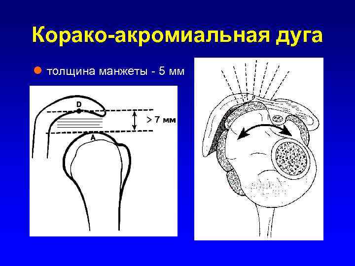 Корако-акромиальная дуга l толщина манжеты - 5 мм 