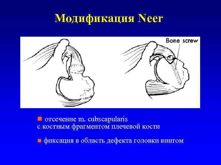 Модификация Neer n отсечение m. cubscapularis с костным фрагментом плечевой кости n фиксация в