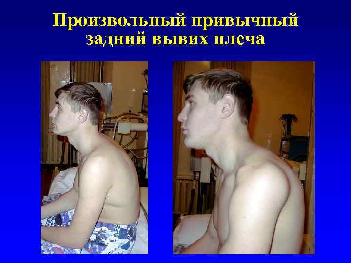 Произвольный привычный задний вывих плеча 