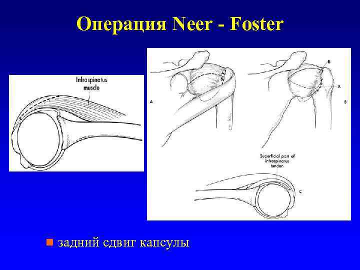 Операция Neer - Foster n задний сдвиг капсулы 