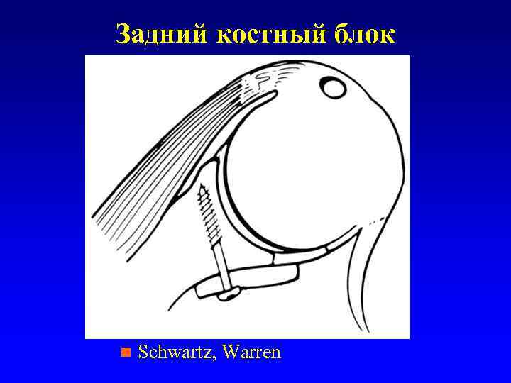 Задний костный блок n Schwartz, Warren 
