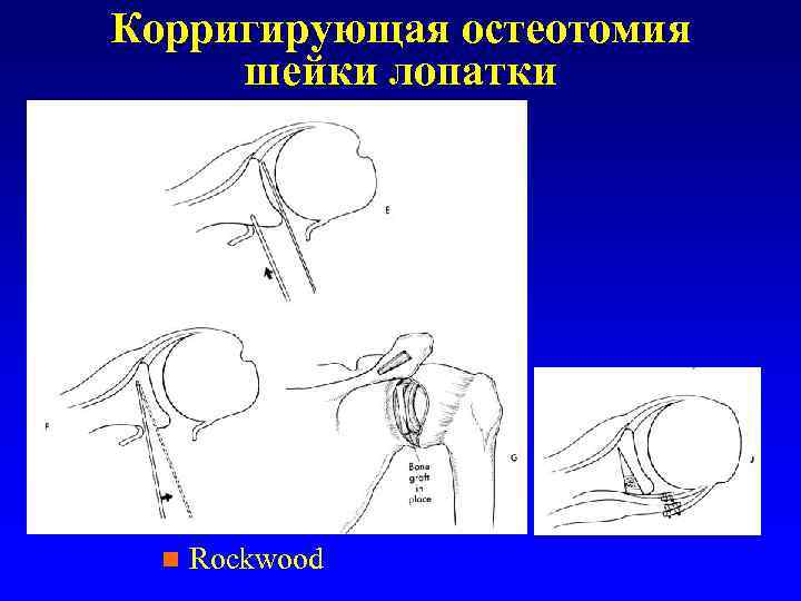 Корригирующая остеотомия шейки лопатки n Rockwood 