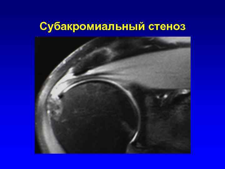 Субакромиальный стеноз 