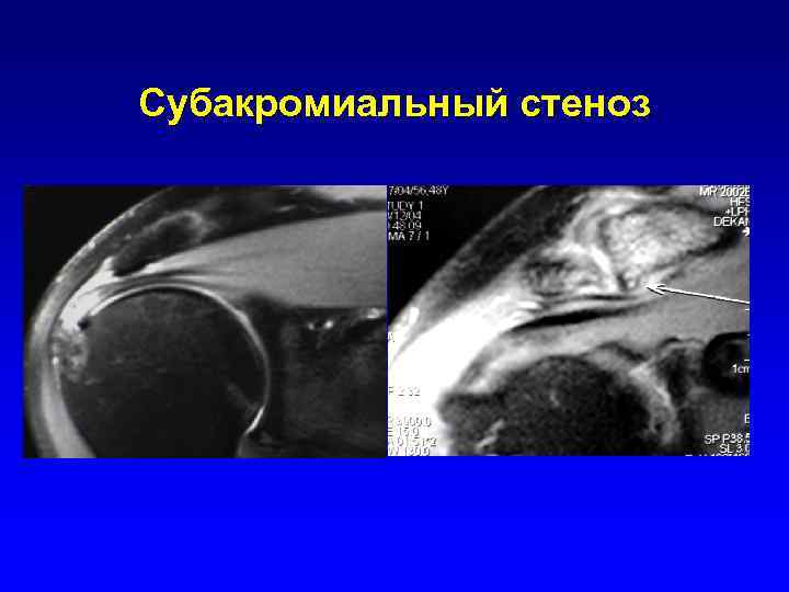 Субакромиальный стеноз 
