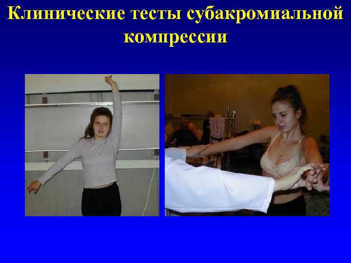 Клинические тесты субакромиальной компрессии 