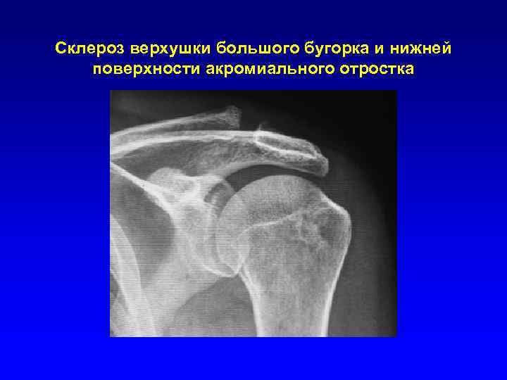 Склероз верхушки большого бугорка и нижней поверхности акромиального отростка 