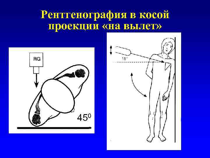 Рентгенография в косой проекции «на вылет» 450 