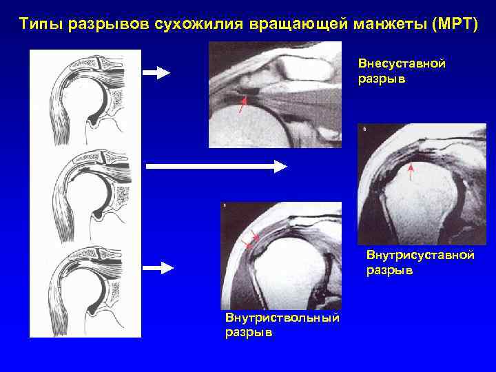 Разрыв сухожилия надостной мышцы плечевого сустава фото