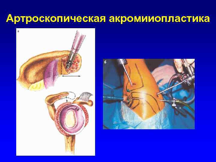 Артроскопическая акромииопластика 