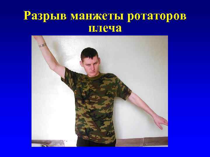 Разрыв манжеты ротаторов плеча 