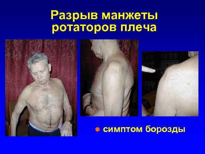 Разрыв манжеты ротаторов плеча l симптом борозды 