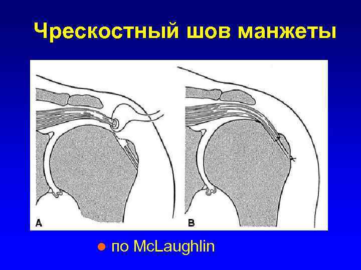 Чрескостный шов манжеты l по Mc. Laughlin 