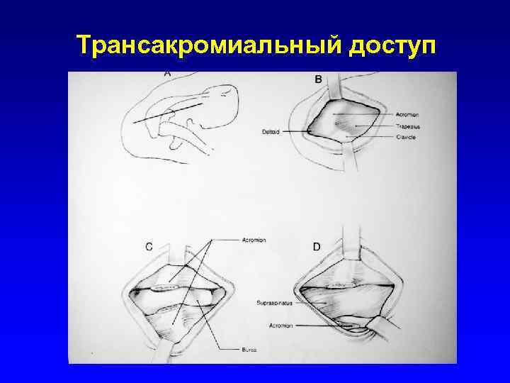 Трансакромиальный доступ 