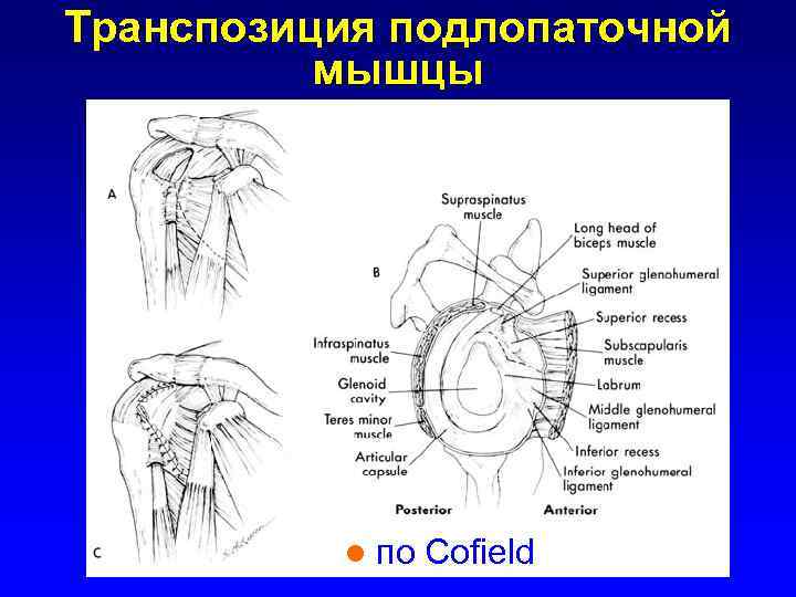 Транспозиция подлопаточной мышцы l по Cofield 