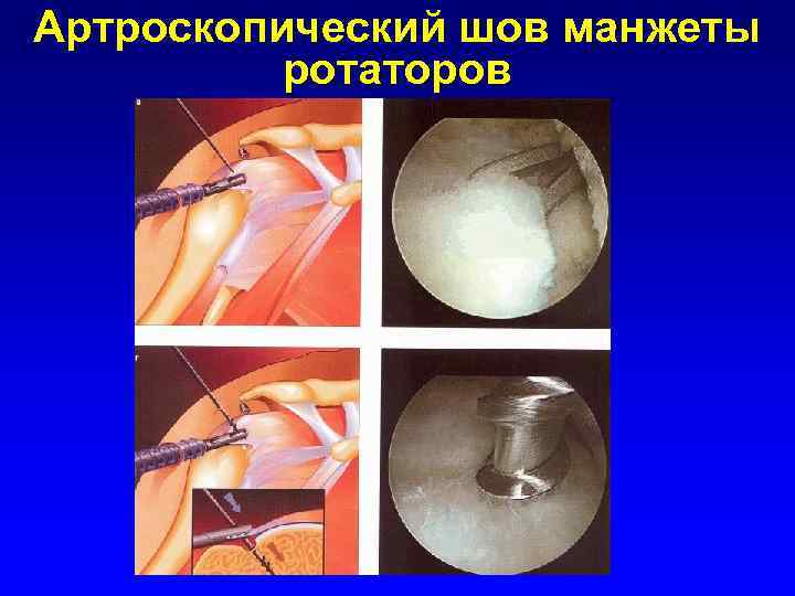 Артроскопический шов манжеты ротаторов 