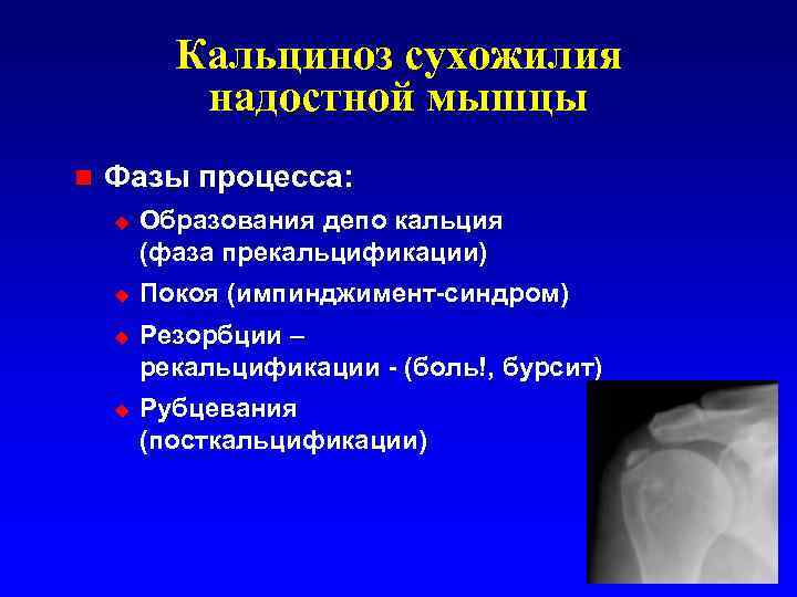Кальциноз сухожилия надостной мышцы n Фазы процесса: u u Образования депо кальция (фаза прекальцификации)