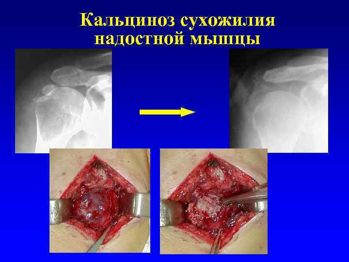 Кальциноз сухожилия надостной мышцы 