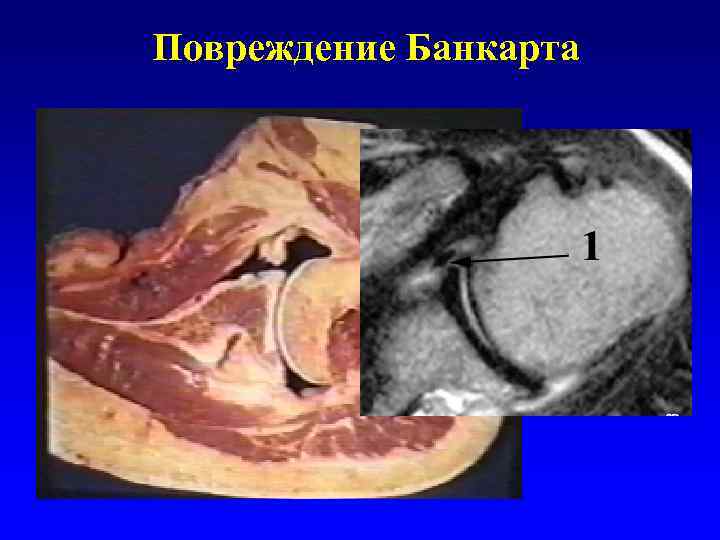 Повреждение Банкарта 