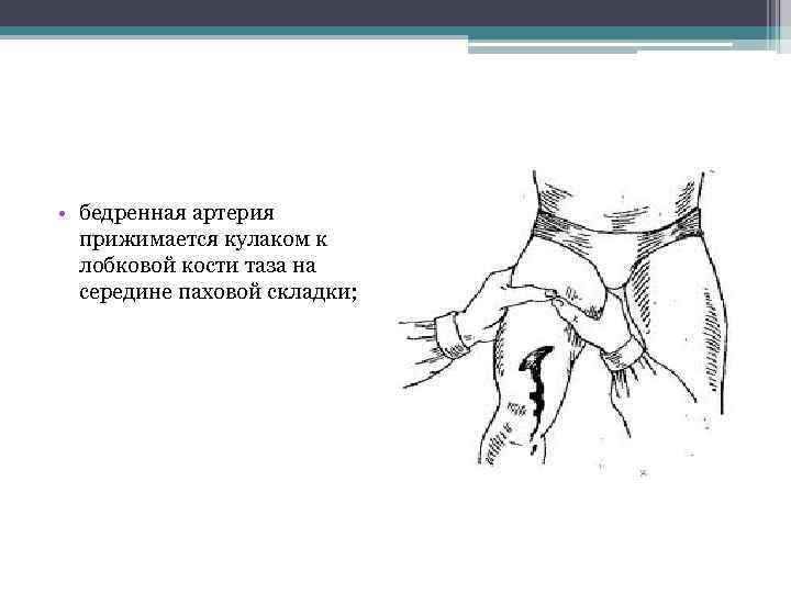 • бедренная артерия прижимается кулаком к лобковой кости таза на середине паховой складки;