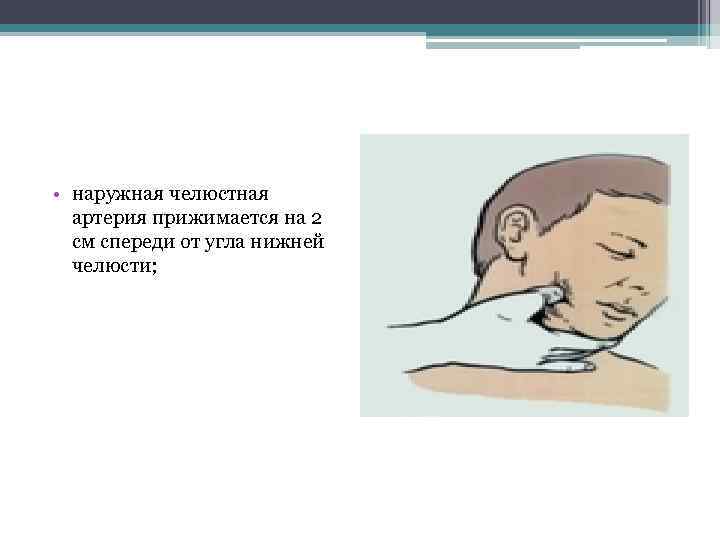  • наружная челюстная артерия прижимается на 2 см спереди от угла нижней челюсти;