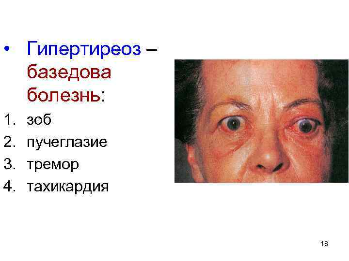  • Гипертиреоз – базедова болезнь: 1. 2. 3. 4. зоб пучеглазие тремор тахикардия