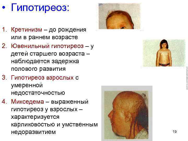  • Гипотиреоз: 1. Кретинизм – до рождения или в раннем возрасте 2. Ювенильный