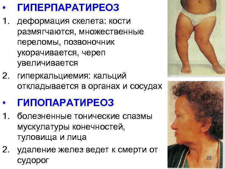  • ГИПЕРПАРАТИРЕОЗ 1. деформация скелета: кости размягчаются, множественные переломы, позвоночник укорачивается, череп увеличивается