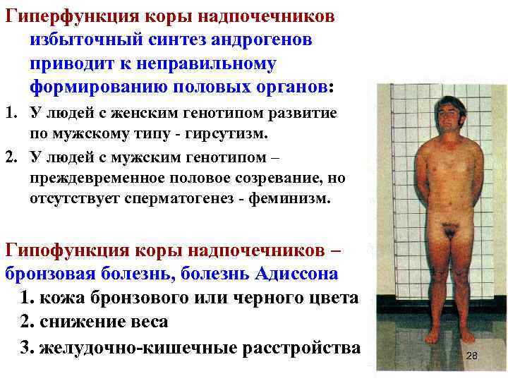 Гиперфункция коры надпочечников избыточный синтез андрогенов приводит к неправильному формированию половых органов: 1. У