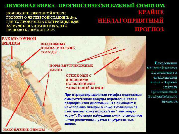 ЛИМОННАЯ КОРКА - ПРОГНОСТИЧЕСКИ ВАЖНЫЙ СИМПТОМ. ПОЯВЛЕНИЕ ЛИМОННОЙ КОРКИ ГОВОРИТ О ЧЕТВЕРТОЙ СТАДИИ РАКА.