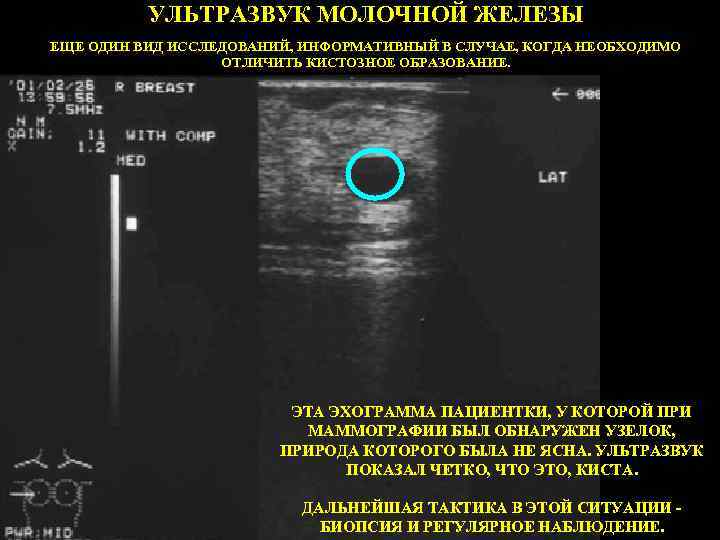 УЛЬТРАЗВУК МОЛОЧНОЙ ЖЕЛЕЗЫ ЕЩЕ ОДИН ВИД ИССЛЕДОВАНИЙ, ИНФОРМАТИВНЫЙ В СЛУЧАЕ, КОГДА НЕОБХОДИМО ОТЛИЧИТЬ КИСТОЗНОЕ