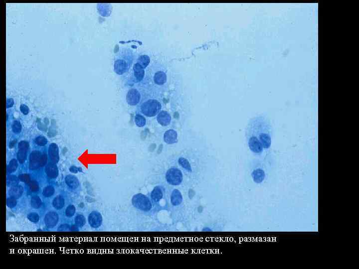 Забранный материал помещен на предметное стекло, размазан и окрашен. Четко видны злокачественные клетки. 