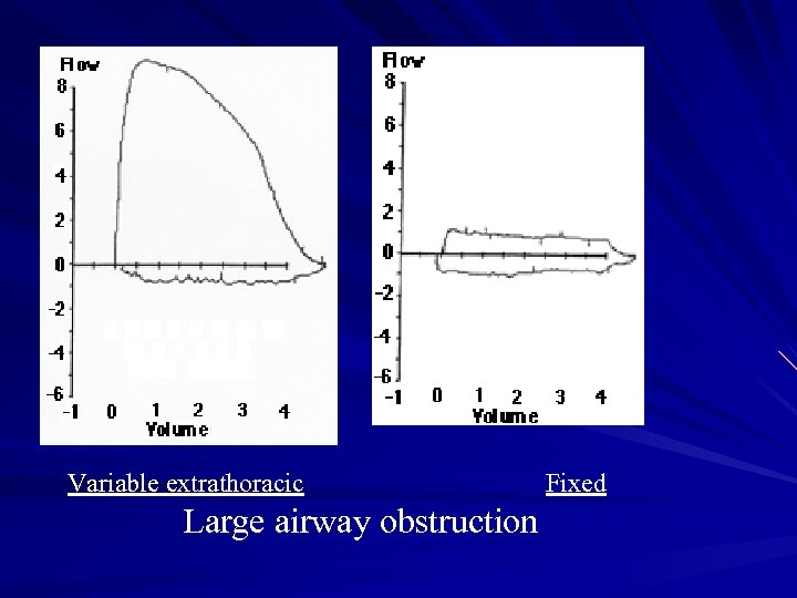 Variable extrathoracic Large airway obstruction Fixed 