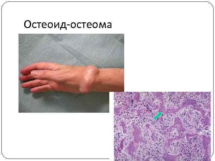 Остеоид-остеома 