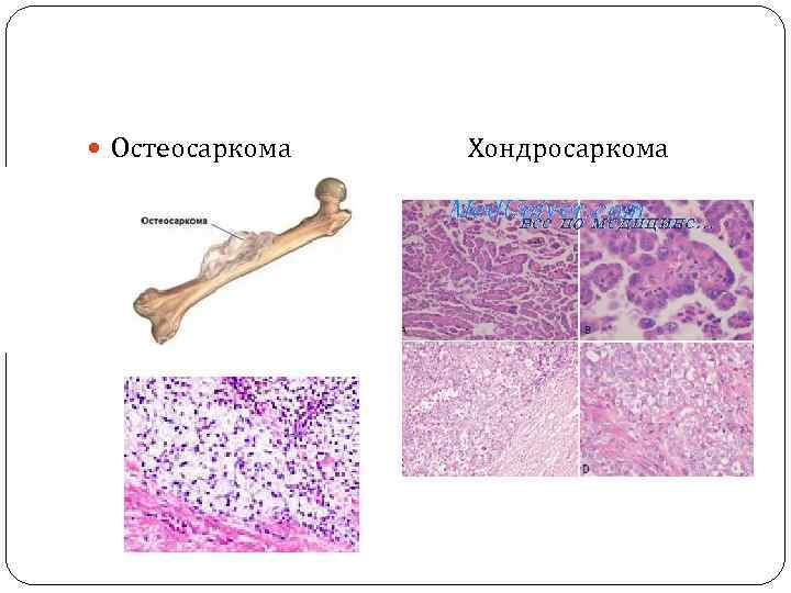  Остеосаркома Хондросаркома 