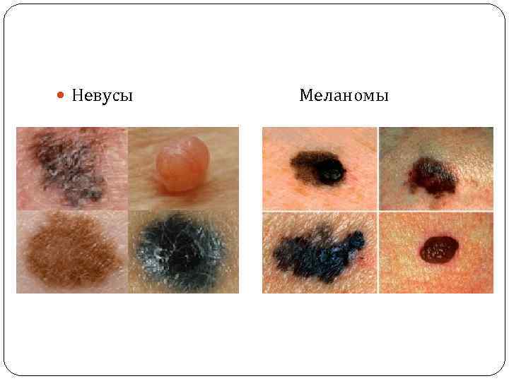  Невусы Меланомы 
