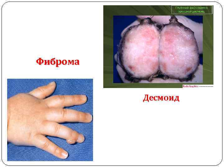 Фиброма Десмоид 