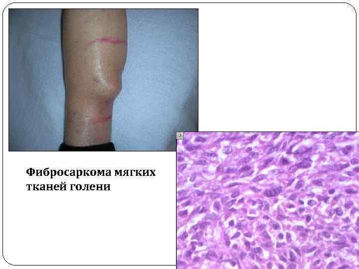 Фибросаркома мягких тканей голени 